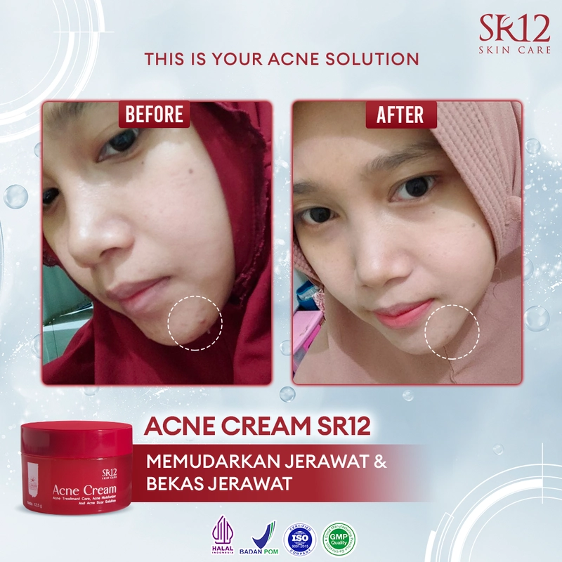 Product image SR12 Acne Cream Mengatasi Jerawat Meradang Pudar Dalam 14 Hari 12.5g Acne Cream