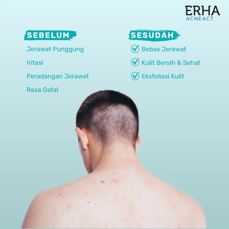 Product image ERHA - BUY 1 GET 1 AcneAct Acne Back Spray 100 ml 100ml Putih