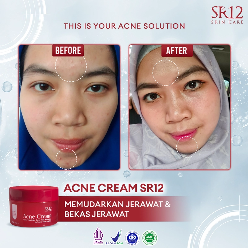 Product image SR12 Acne Cream Mengatasi Jerawat Meradang Pudar Dalam 14 Hari 12.5g Acne Cream