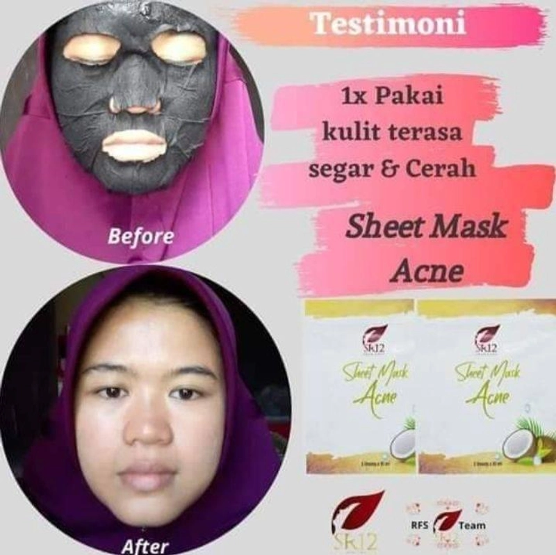Product image Sheet Mask Acne SR12 Masker Topeng Mengatasi Jerawat Komedo Bruntusan Melembabkan Kulit 5 Sheets Acne