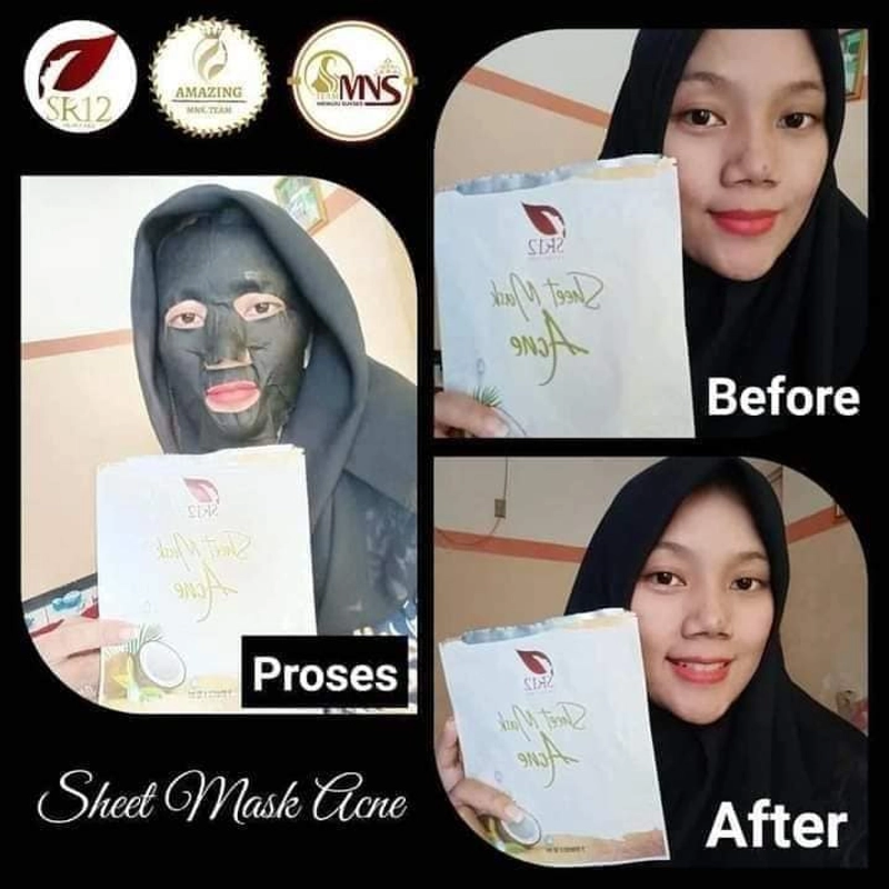 Product image Sheet Mask Acne SR12 Masker Topeng Mengatasi Jerawat Komedo Bruntusan Melembabkan Kulit 5 Sheets Acne