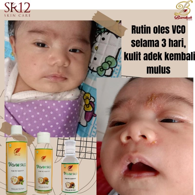 Product image SR12 VCO Minyak Kelapa Murni Mengatasi Ruam Iritasi 60 ml VCO Cair