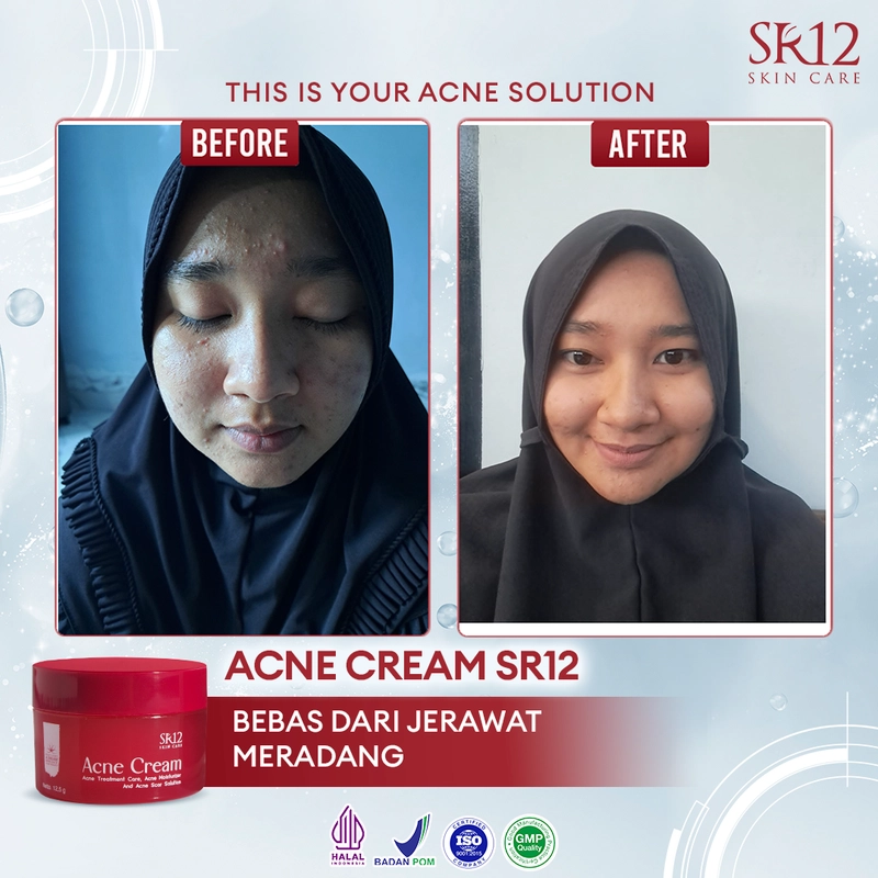Product image SR12 Acne Cream Mengatasi Jerawat Meradang Pudar Dalam 14 Hari 12.5g Acne Cream