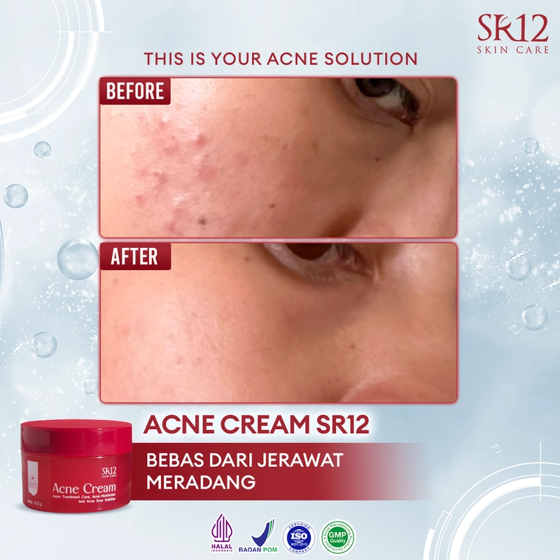 Product image SR12 Acne Cream Mengatasi Jerawat Meradang Pudar Dalam 14 Hari 12.5g Acne Cream