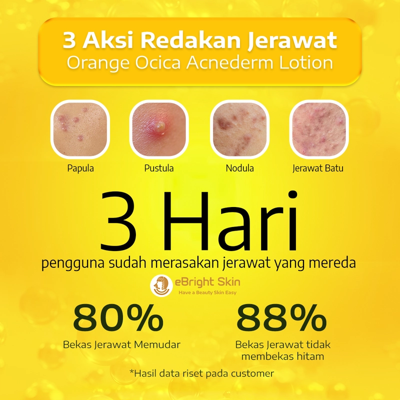 Product image eBright Skin - Orange O Cica Acnederm Lotion - Lotion Jerawat Meradang 15ml Cream