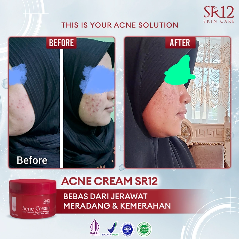 Product image SR12 Acne Cream Mengatasi Jerawat Meradang Pudar Dalam 14 Hari 12.5g Acne Cream