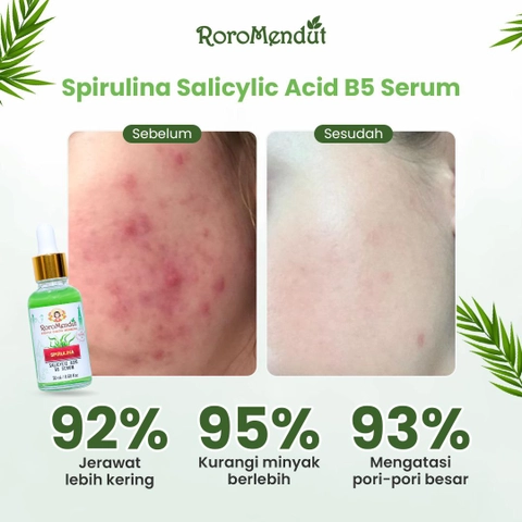 Roro Mendut Skincare - Serum Salicylic Acid B5 Spirulina Anti Jerawat